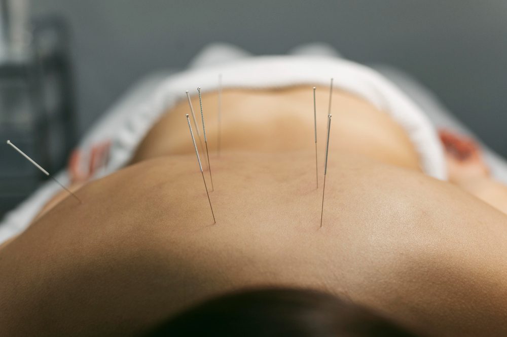 Dry Needling Therapy In Stuart, Fl
