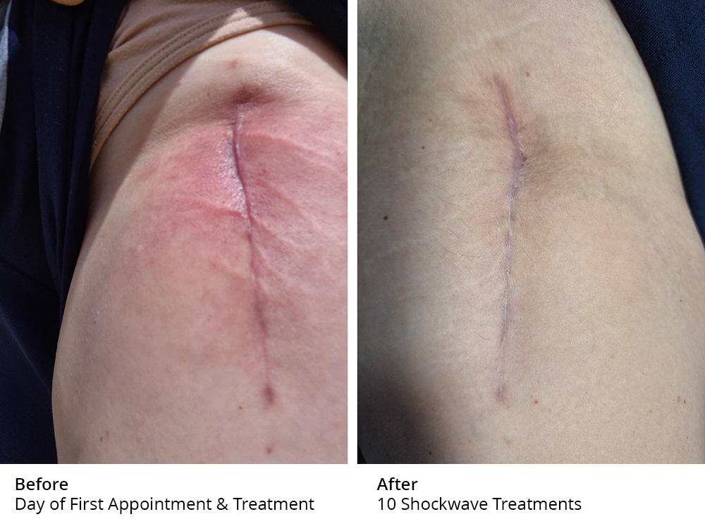 Shockwave_after Hip Pain &Amp; Surgery Recovery Success Stories