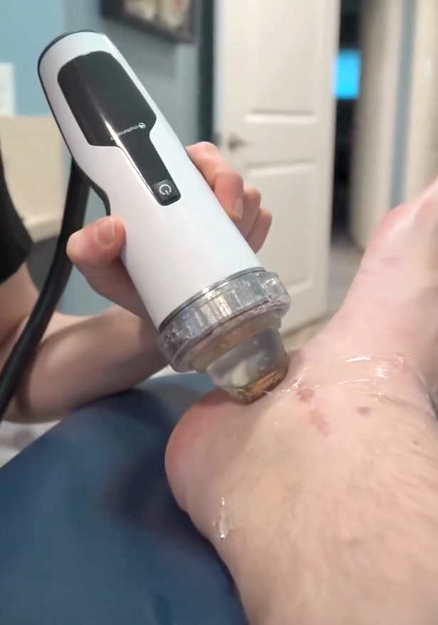 Shockwave Therapy Focus-Shockwave Therapy In Stuart, Fl